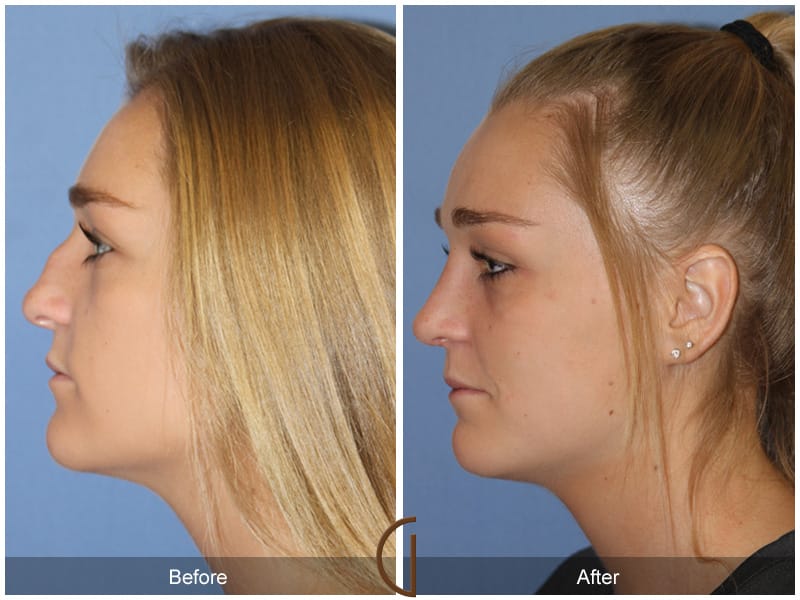 Rhinoplasty Nose Surgery San Clemente CA 113 Image