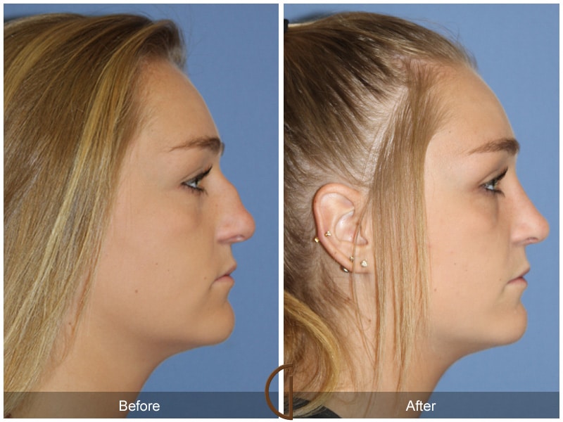 Rhinoplasty Nose Surgery San Clemente CA 113 Image