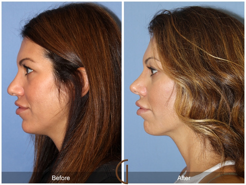 Rhinoplasty Nose Surgery Laguna Hills CA 114 Image
