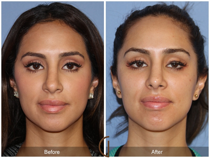 Rhinoplasty Nose Surgery Dana Point CA 115 Image