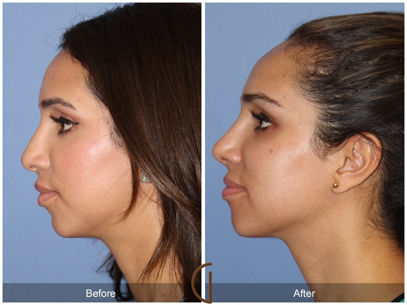 Rhinoplasty Nose Surgery Dana Point CA 115 Image