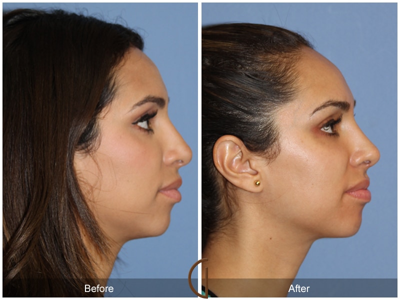 Rhinoplasty Nose Surgery Dana Point CA 115 Image