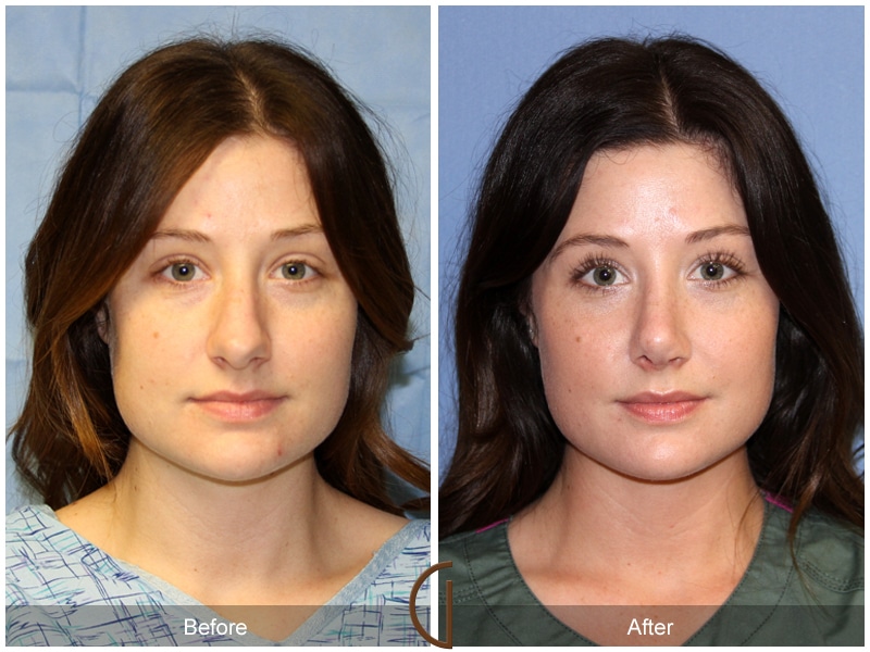 Rhinoplasty Nose Surgery La Palma CA 116 Image