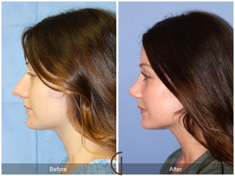 Rhinoplasty Nose Surgery La Palma CA 116 Image