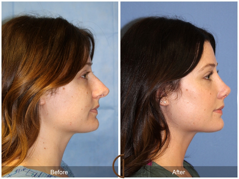 Rhinoplasty Nose Surgery La Palma CA 116 Image