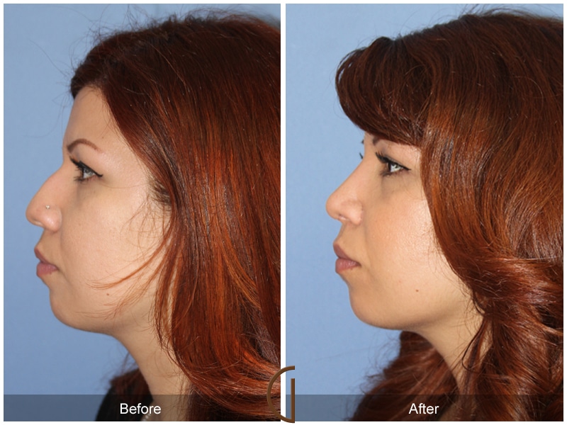 Rhinoplasty Nose Surgery Cypress CA 117 Image