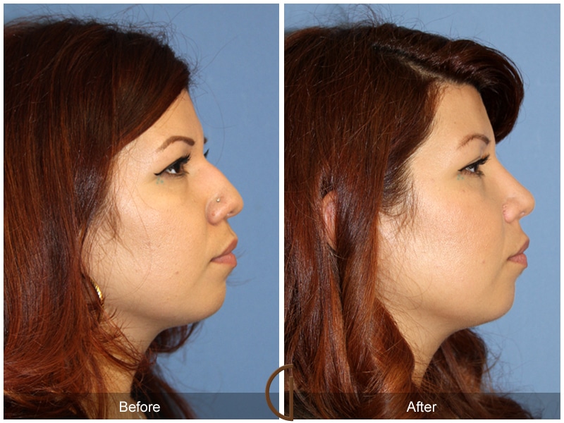 Rhinoplasty Nose Surgery Cypress CA 117 Image