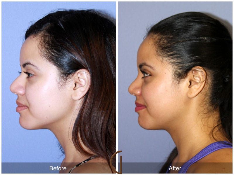 Rhinoplasty Nose Surgery Fountain Valley CA 119 Image
