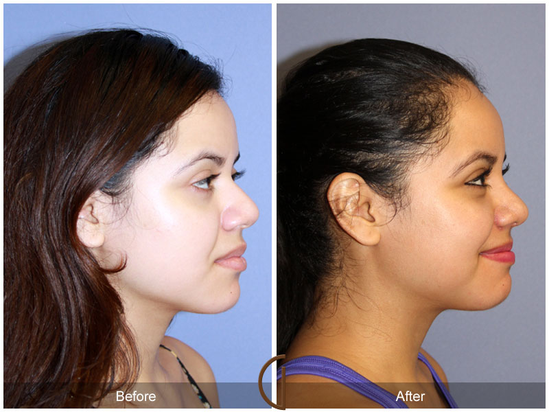 Rhinoplasty Nose Surgery Fountain Valley CA 119 Image