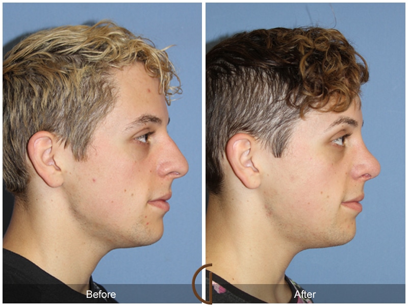 Rhinoplasty Nose Surgery Orange CA 131 Image