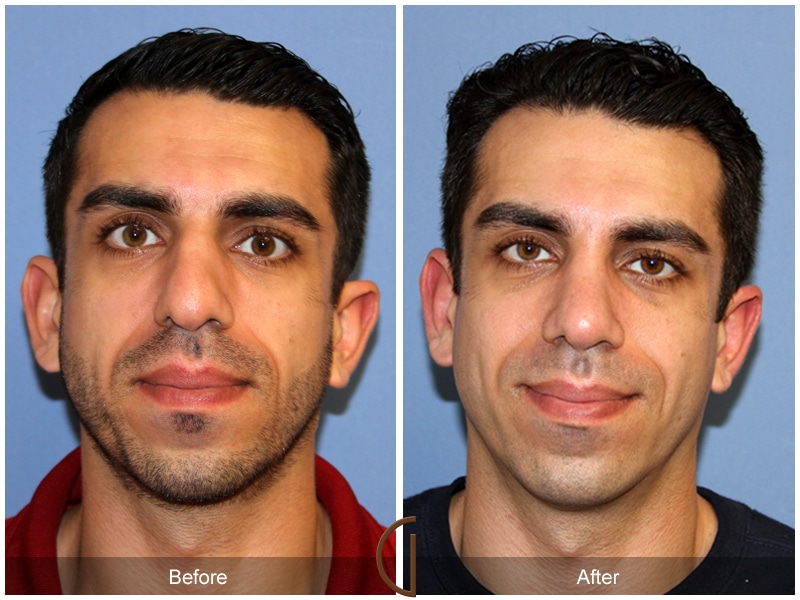 Rhinoplasty Nose Surgery San Juan Capistrano CA 132 Image