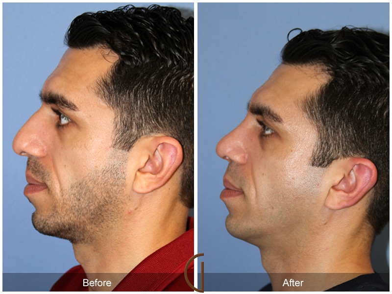 Rhinoplasty Nose Surgery San Juan Capistrano CA 132 Image
