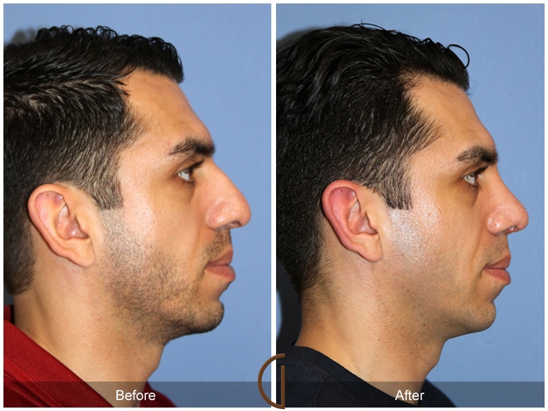 Rhinoplasty Nose Surgery San Juan Capistrano CA 132 Image
