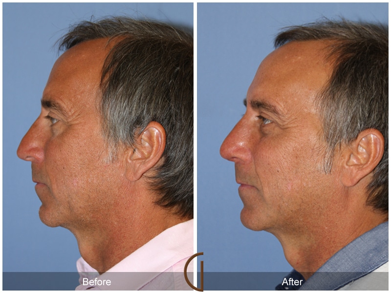 Rhinoplasty Nose Surgery Tustin CA 133 Image