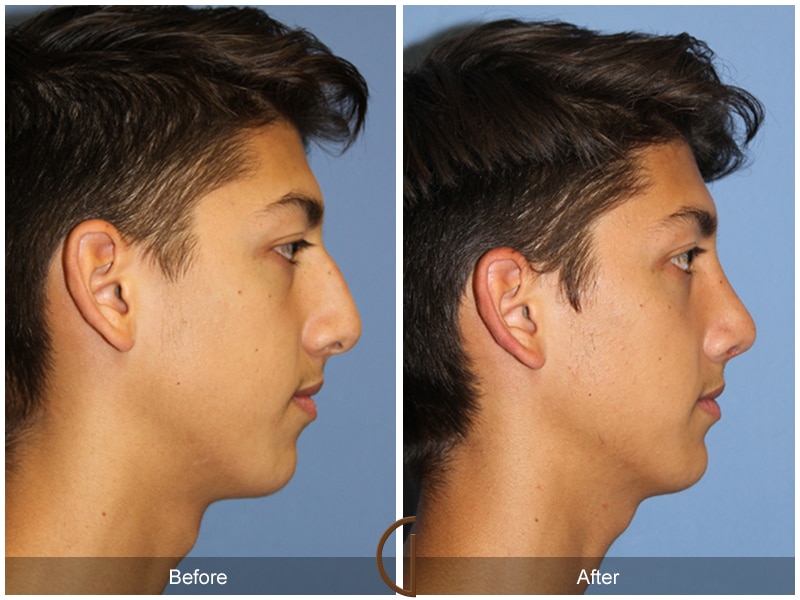 Rhinoplasty Nose Surgery Buena Park CA 134 Image