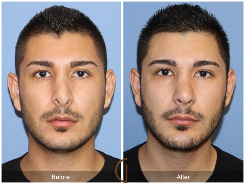 Rhinoplasty Nose Surgery Costa Mesa CA 135 Image