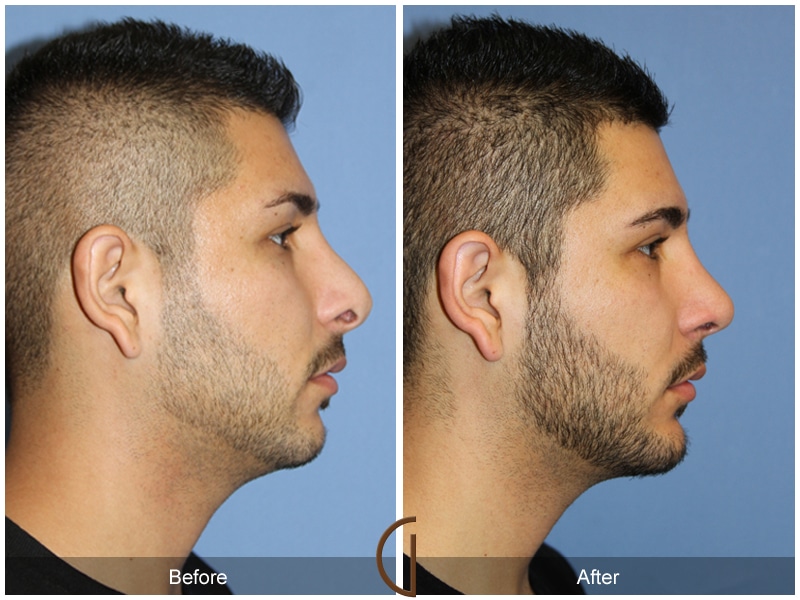 Rhinoplasty Nose Surgery Costa Mesa CA 135 Image
