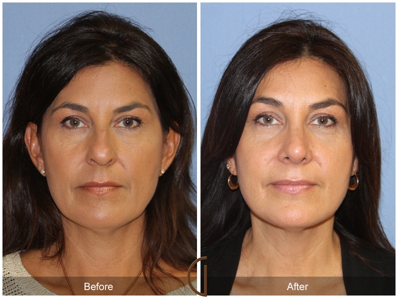Rhinoplasty Nose Surgery Fullerton CA 136 Image