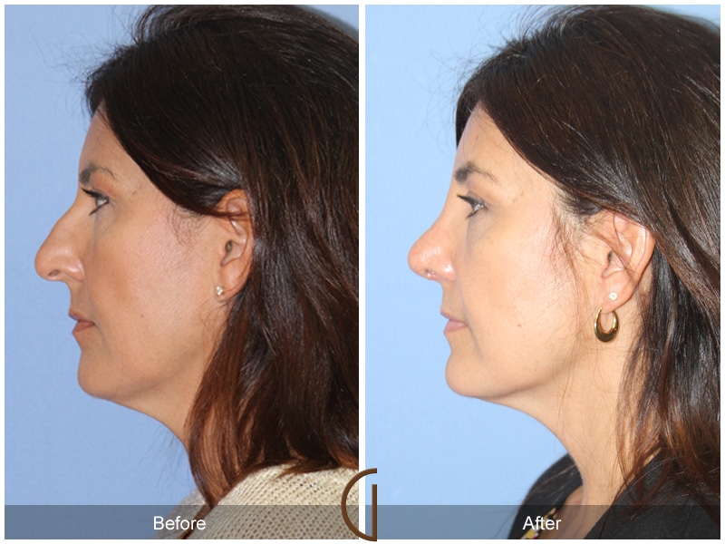 Rhinoplasty Nose Surgery Fullerton CA 136 Image
