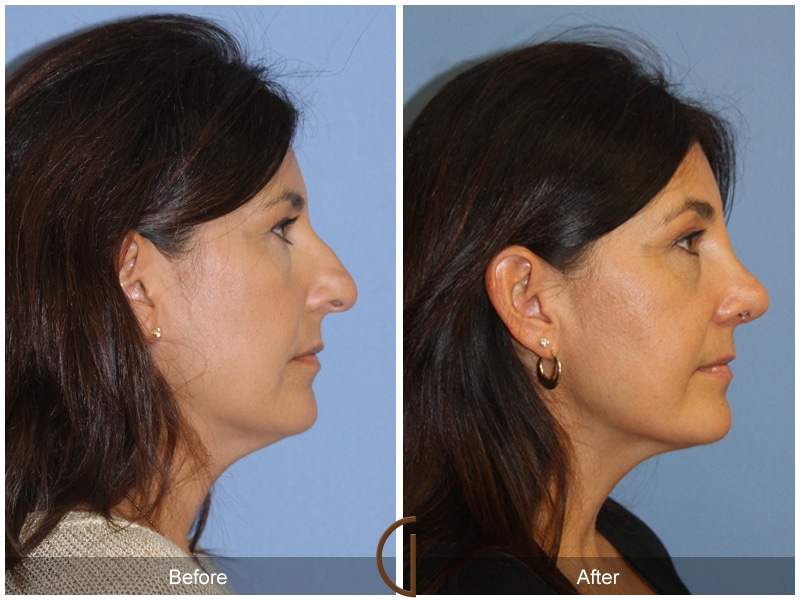 Rhinoplasty Nose Surgery Fullerton CA 136 Image