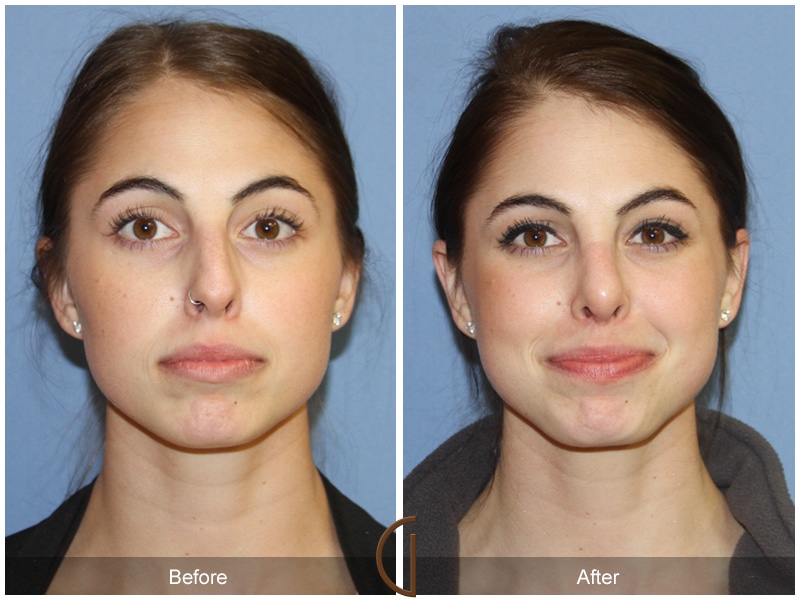 Rhinoplasty Nose Surgery Valley Center CA 95 Image