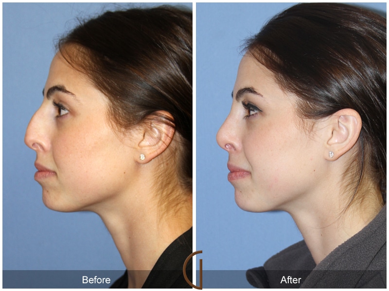 Rhinoplasty Nose Surgery Valley Center CA 95 Image