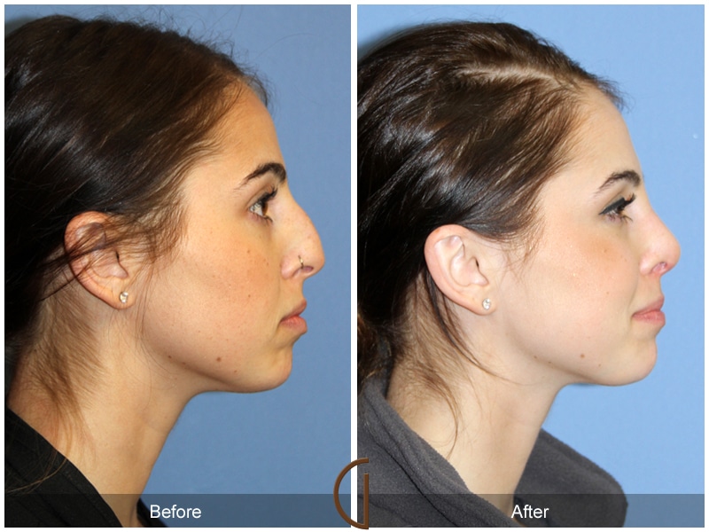Rhinoplasty Nose Surgery Valley Center CA 95 Image