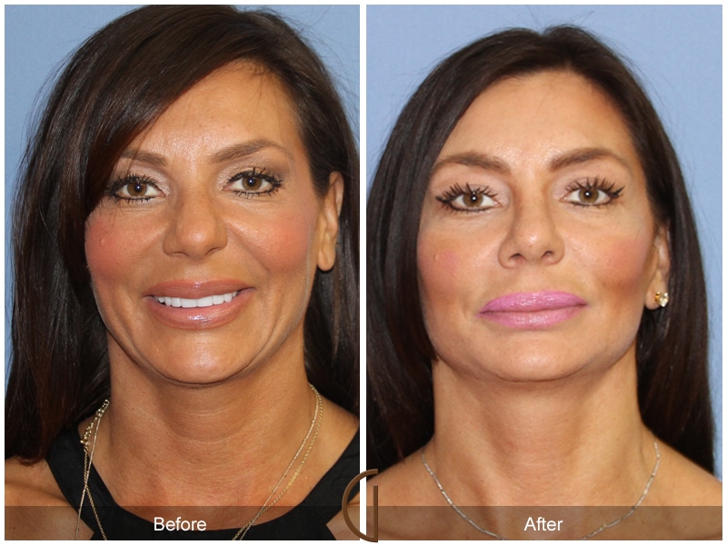 Rhinoplasty Nose Surgery Woodcrest CA 92 Image