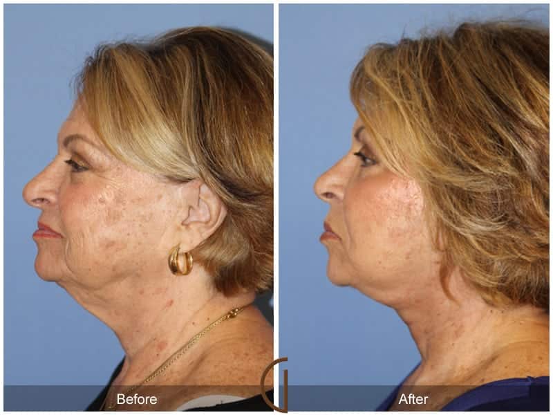 Facelift Orange County 203 Image