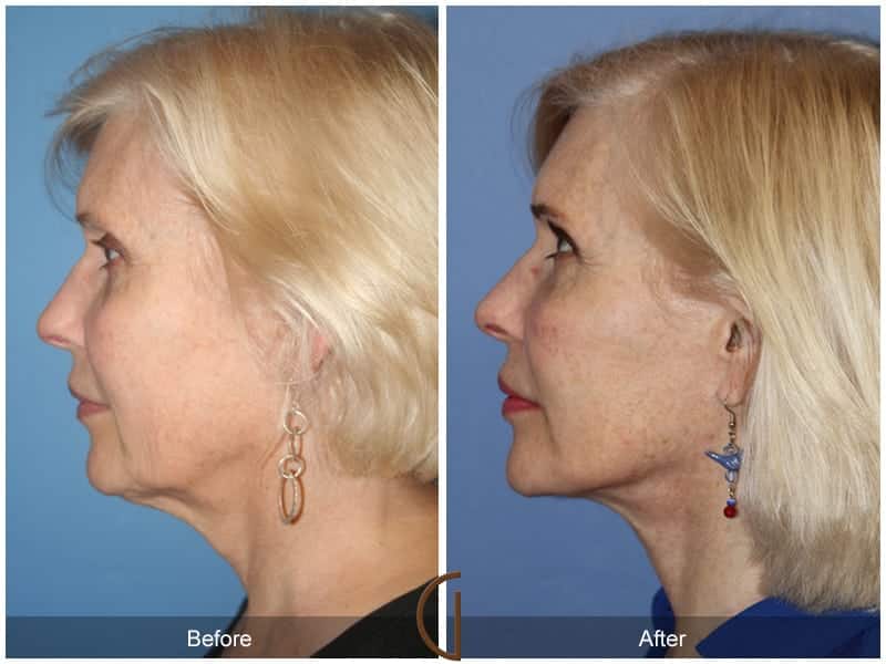 Facial Fat Grafting La Palma CA 9 Image