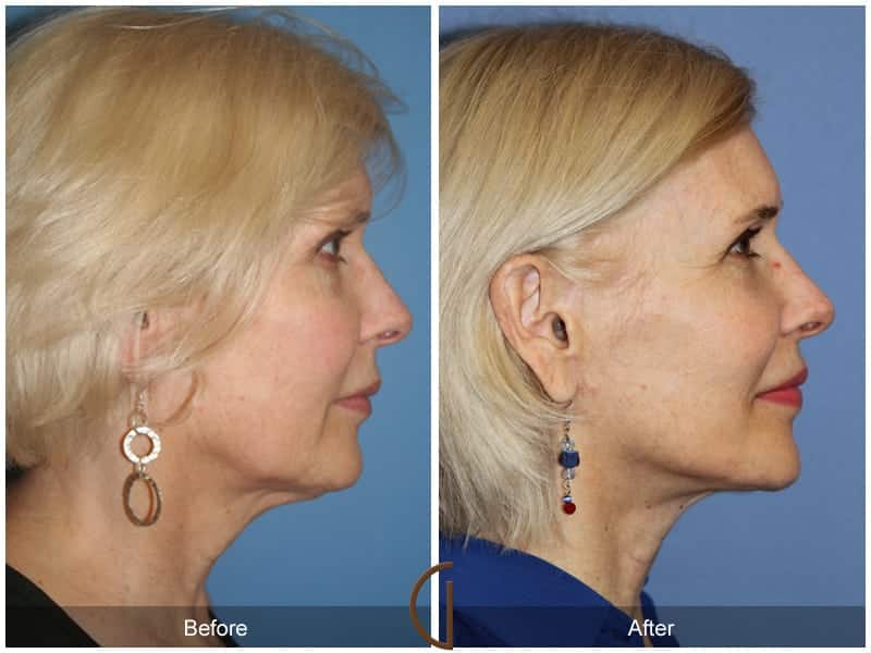 Facial Fat Grafting La Palma CA 9 Image