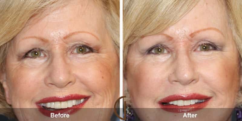 Eyelid Surgery Orange County 34 Image