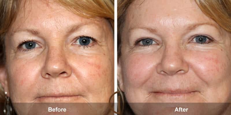 Eyelid Surgery Orange County 33 Image