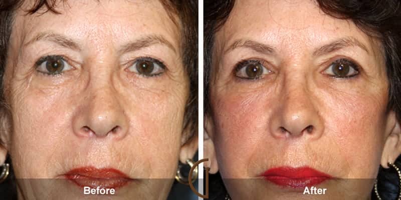 Eyelid Surgery Orange County 32 Image