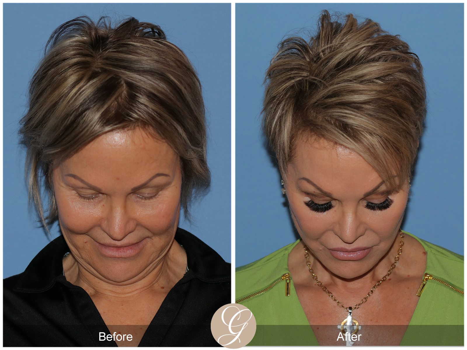 Preservation Facelift Case 20 Image