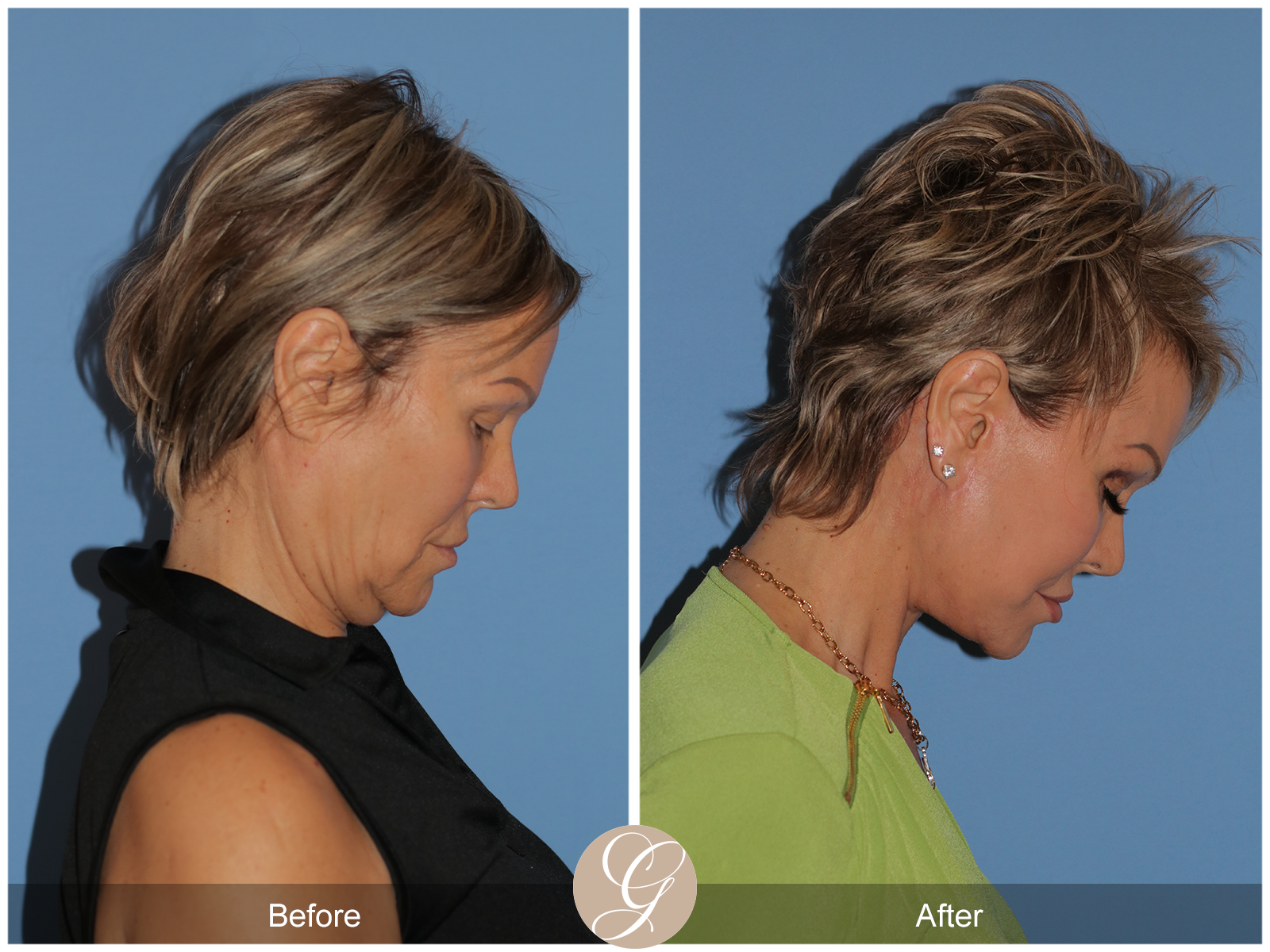 Preservation Facelift Case 20 Image