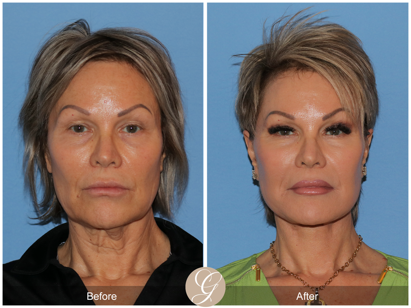 Preservation Facelift Case 20 Image