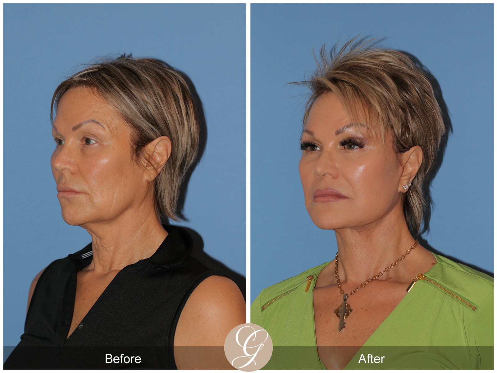 Preservation Facelift Case 20 Image