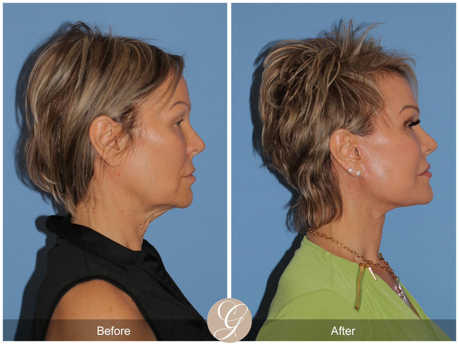 Preservation Facelift Case 20 Image