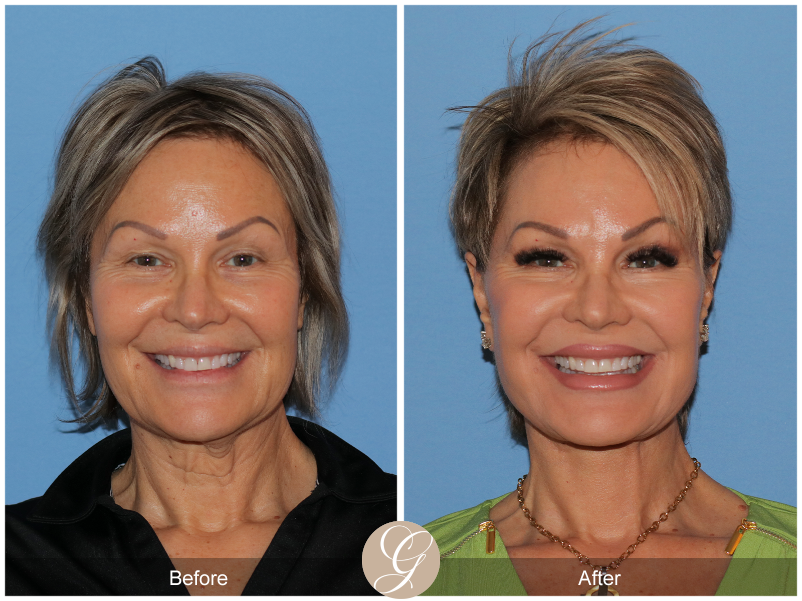 Preservation Facelift Case 20 Image