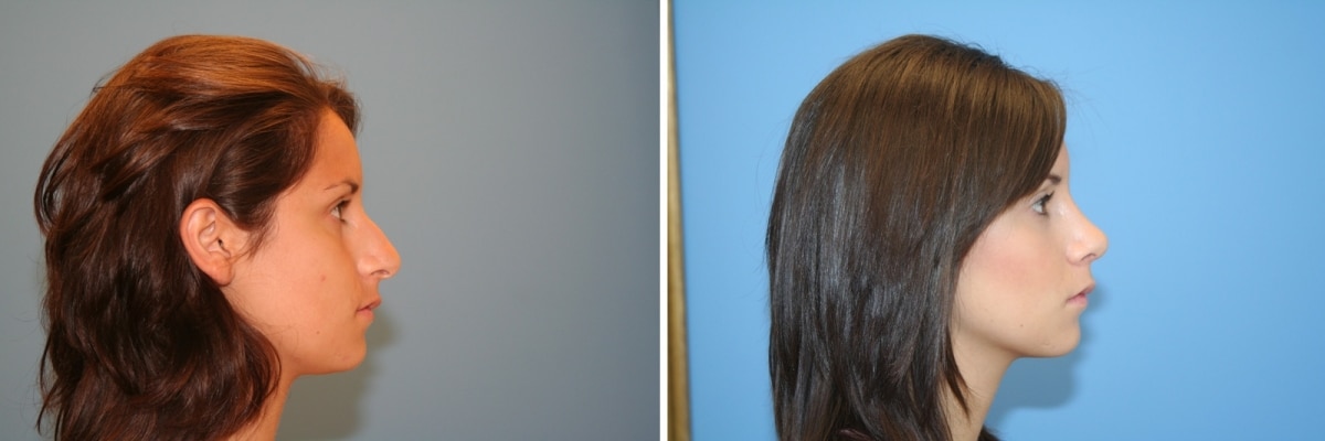 Tips for a Quick Recovery from a Rhinoplasty Image