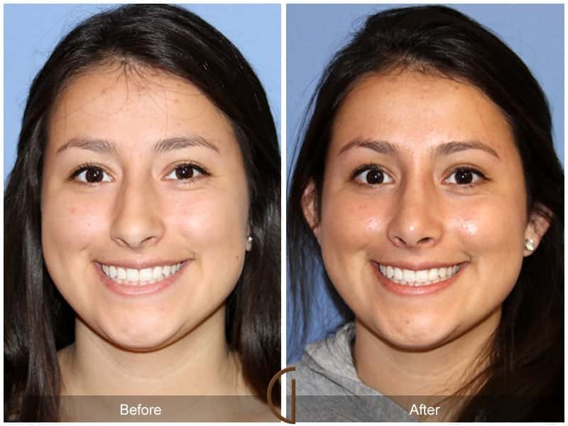 Ethnic Rhinoplasty Orange County 93 Image