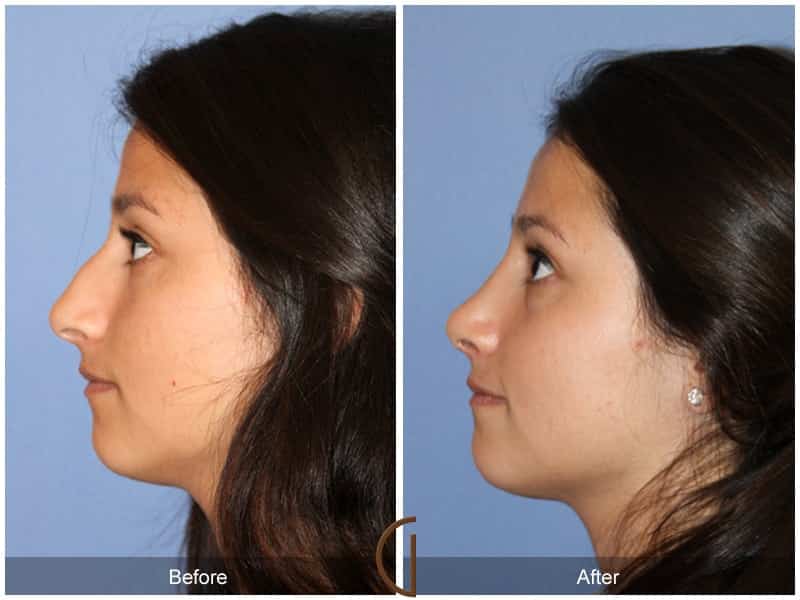 Ethnic Rhinoplasty Orange County 93 Image