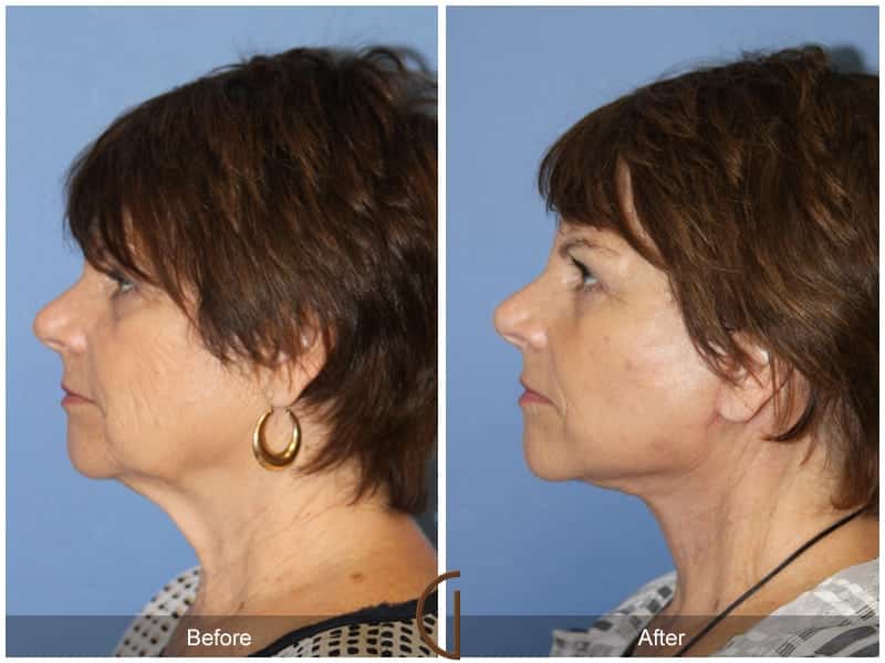 Facelift Newport Beach 204 Image