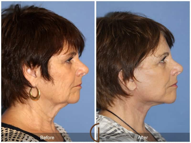 Facelift Newport Beach 204 Image