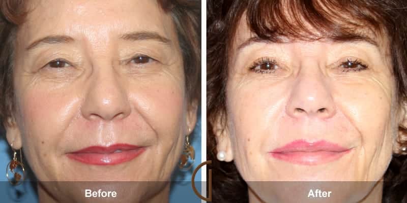 Eyelid Surgery Orange County 31 Image