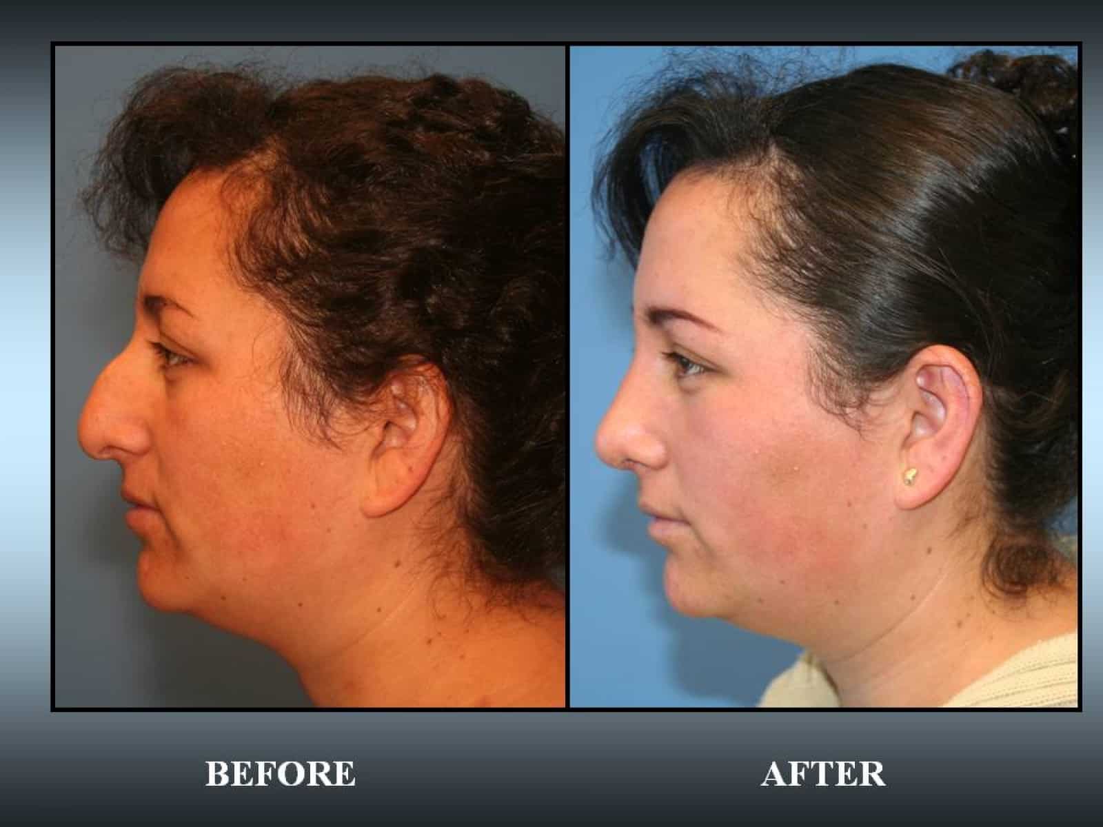 Reduction Rhinoplasty of Nasal Bump in California Image