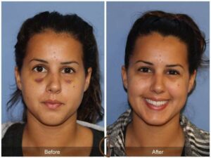 Revision Rhinoplasty Costa Mesa CA