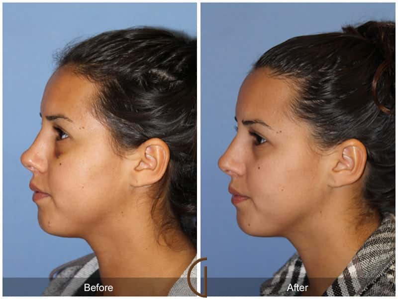 Rhinoplasty Costa Mesa 105 Image