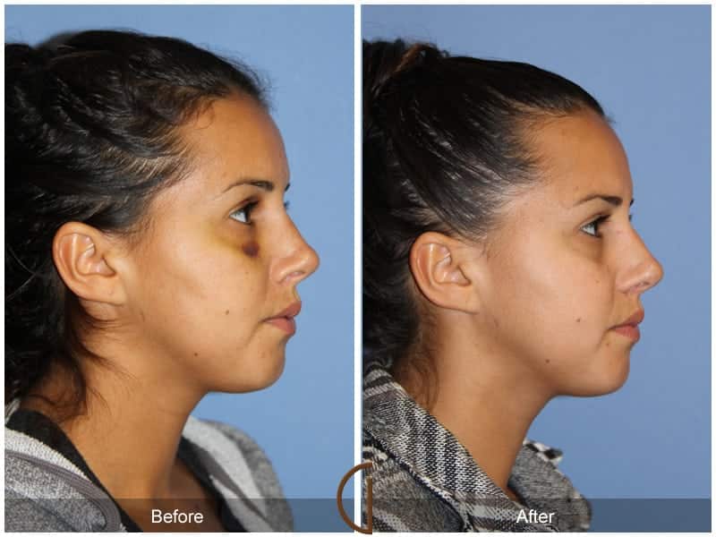 Rhinoplasty Costa Mesa 105 Image